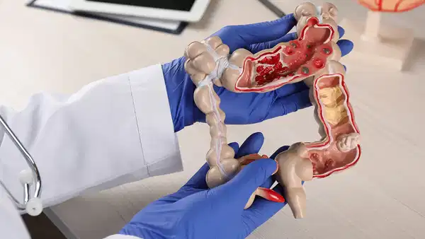 Genetik Faktörler Kolon Kanseri Riskinizi Artırabilir: 40 Yaşında Kontrol Gerekiyor!